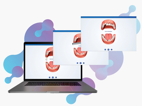 PlanMaster fogászati szoftver személyre szabott 3D animációi látszanak a laptopon színes háttérrel